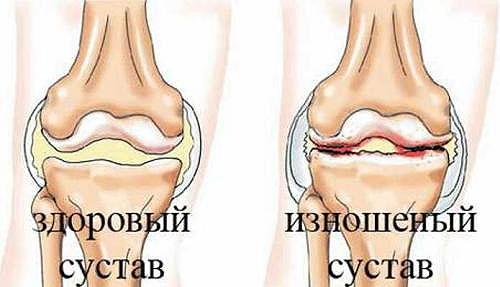 Симптомы артроза